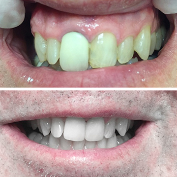 Tooth Restoration Patient