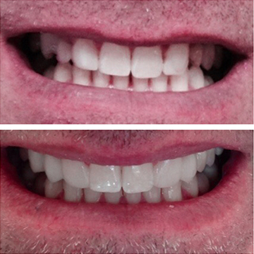 Smile Makeover Patient 10