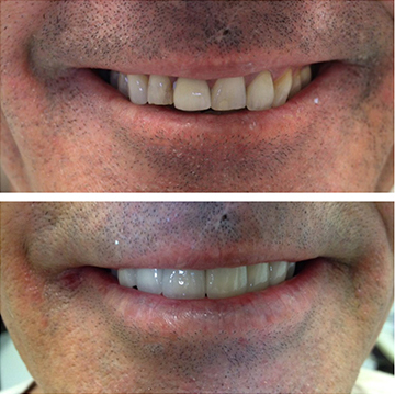 Smile Makeover Patient 13