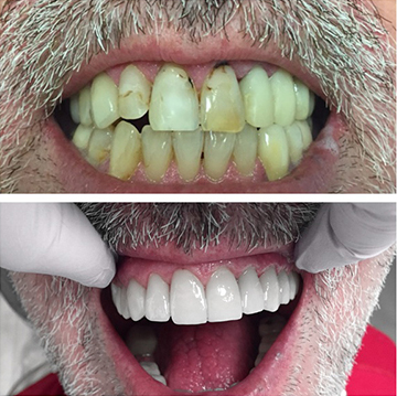 Tooth Restoration patient