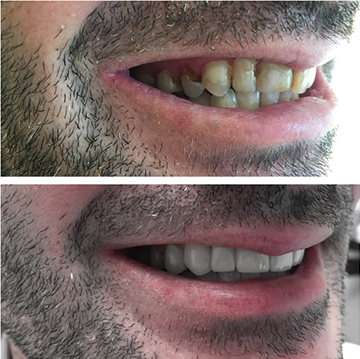Smile Makeover Patient 2