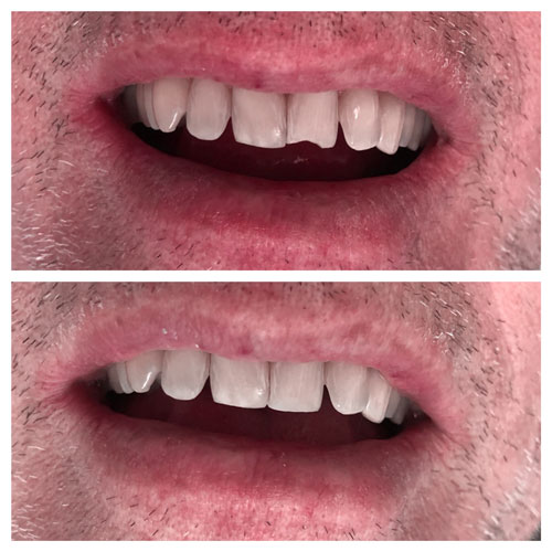 Smile Makeover Patient 15