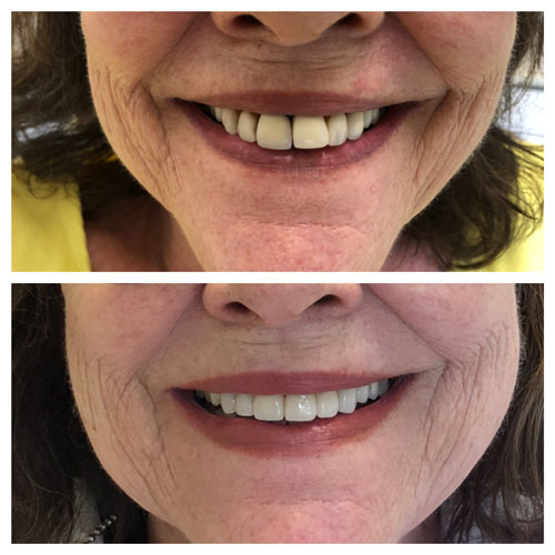 Smile Makeover Patient 16