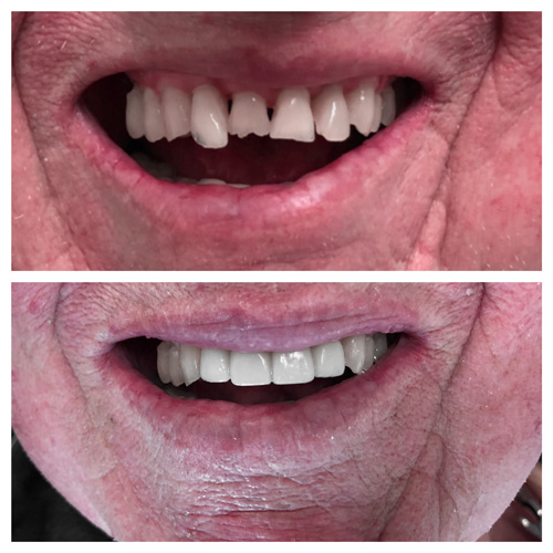 Smile Makeover Patient 17