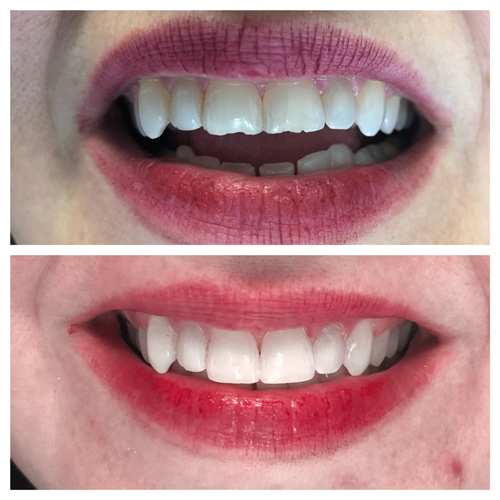 Smile Makeover Patient 18
