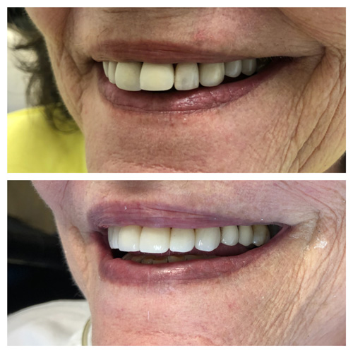Smile Makeover Patient 20