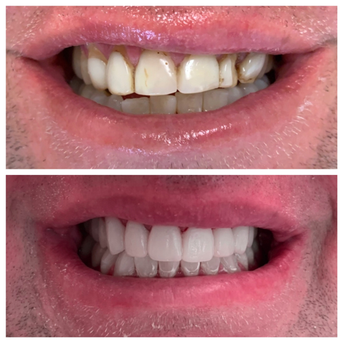 Smile Makeover Patient 21