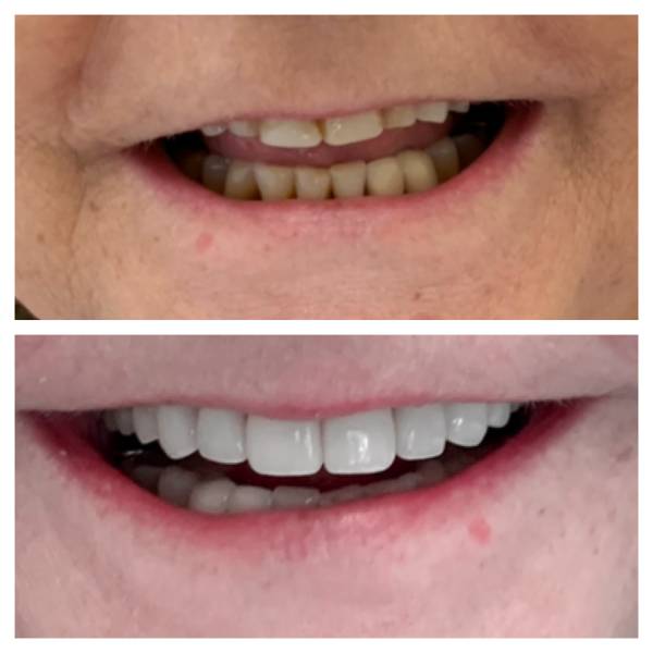 Smile Makeover Patient 22