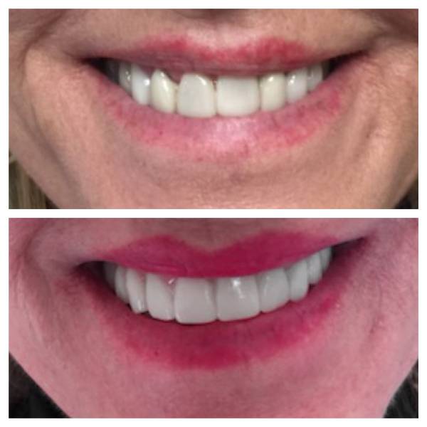 Smile Makeover Patient 23