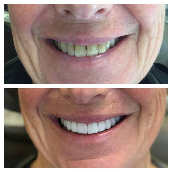 Smile Makeover Patient 25