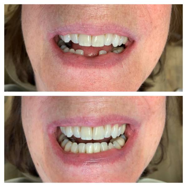 Smile Makeover Patient 26