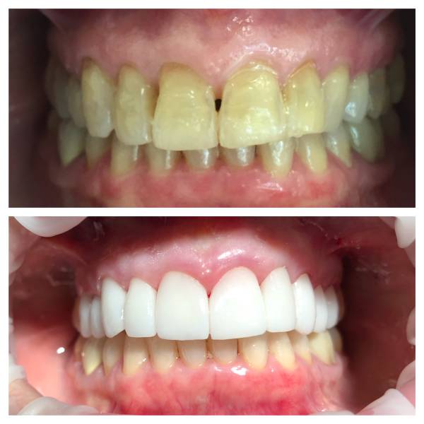 Smile Makeover Patient 28